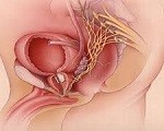 Tumore prostata