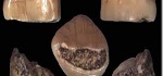 Dente bambino Isernia