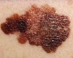 Nei pelle melanoma