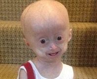 Lucy bambina anziana progeria