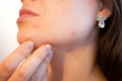 eczema pelle