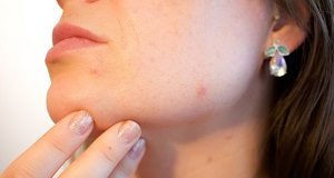 eczema pelle