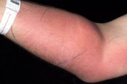 Si inetta sperma nel bracci per curare mal di schiena