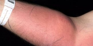 Si inetta sperma nel bracci per curare mal di schiena