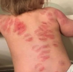 Bambina morsi schiena scuola