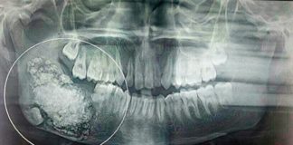 Ragazzo indiano gli tolgono 232 denti
