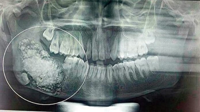 Ragazzo indiano gli tolgono 232 denti