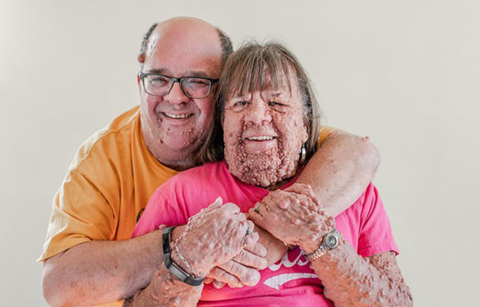Neurofibromatosi
