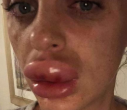 Labbra botox