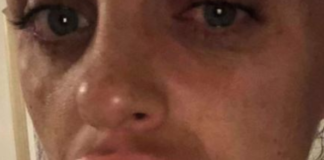 Labbra botox