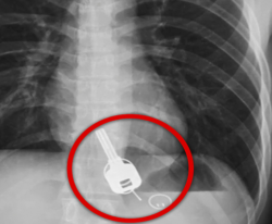 Radiografia mazzo di chiavi