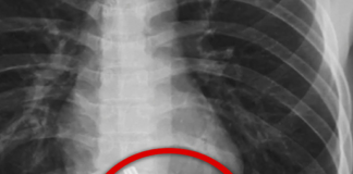Radiografia mazzo di chiavi