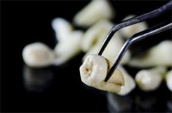Dente estratto
