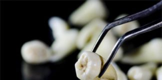 Dente estratto