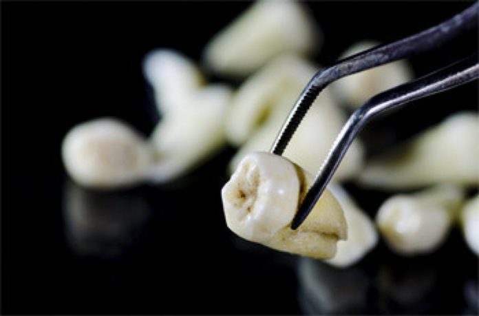 Dente estratto