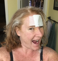 Donna melanoma