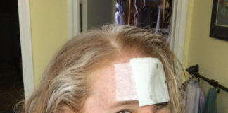 Donna melanoma