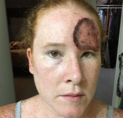 Melanoma