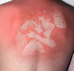 Sunburn art