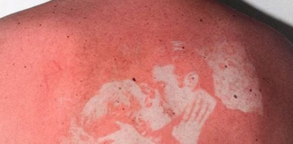 Sunburn art